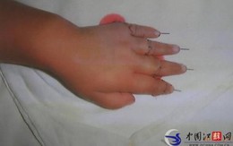 Bé gái 2 tuổi nghịch dao chặt đứt 4 ngón tay